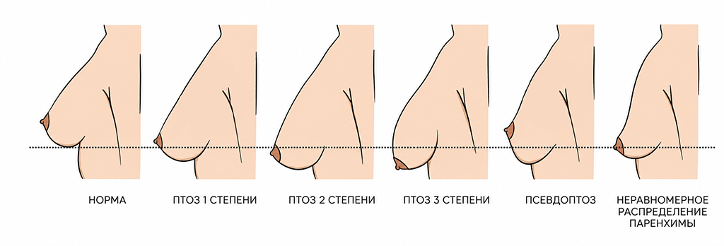 степени птоза молочных желез