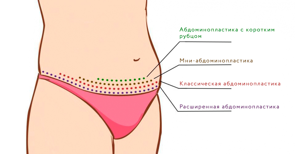 Виды-абдоминопластики.jpg
