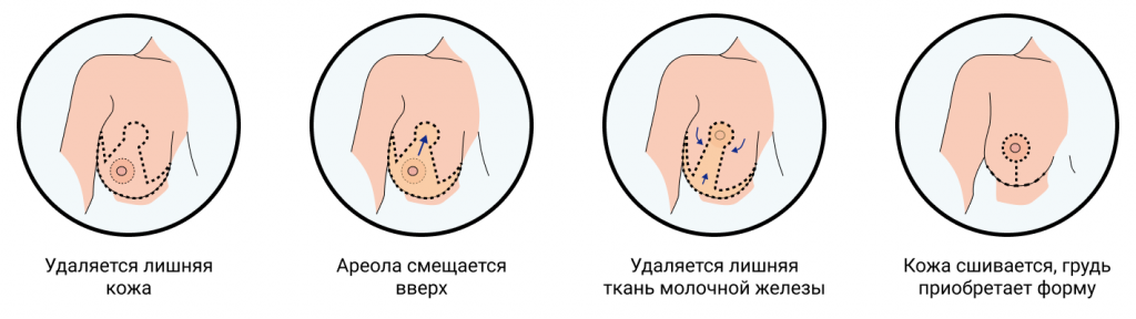 как хирургически уменьшют грудь