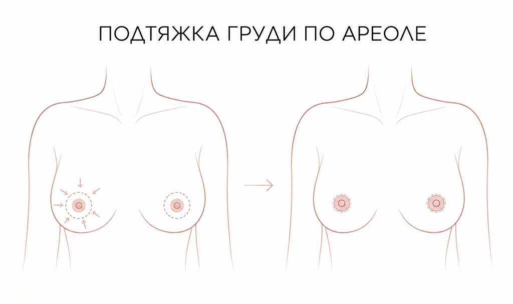 ареолярная мастопексия